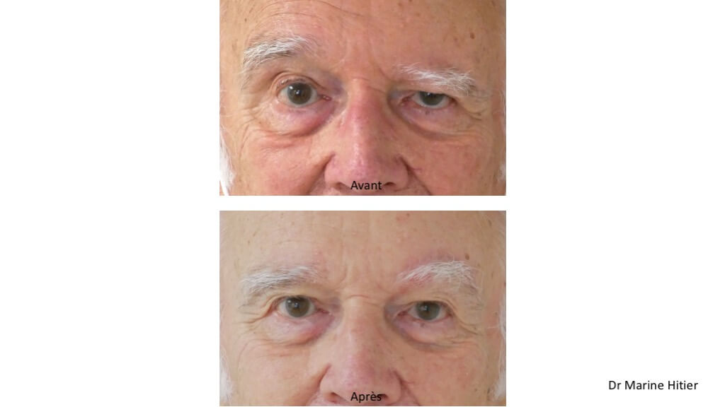 Lifting sourcil Résection supra-sourcilière
