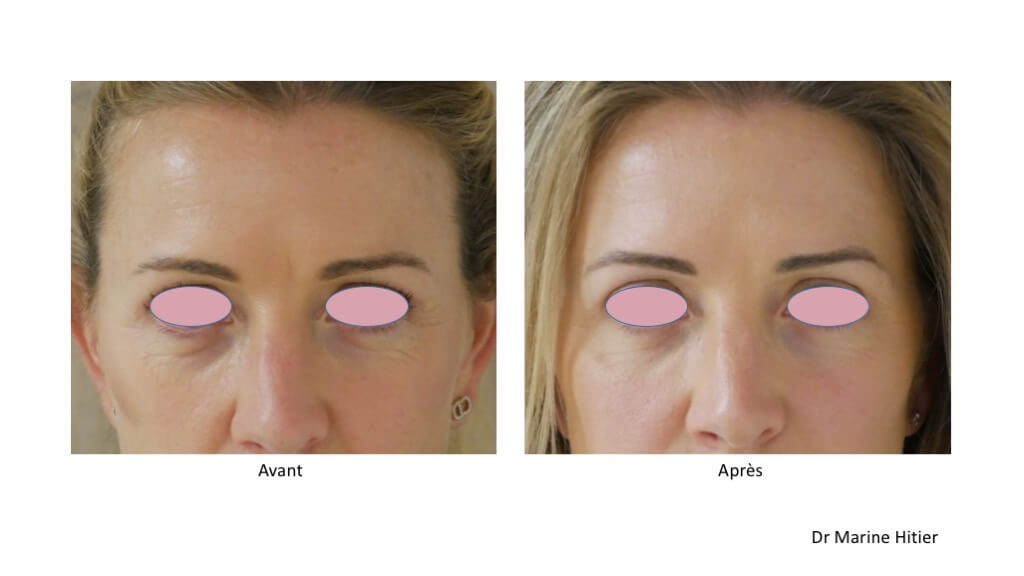 avant après Chatelain injections