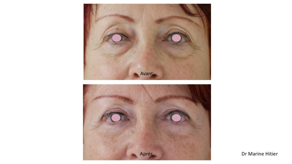 blepharoplastie 4 paupières lipofilling