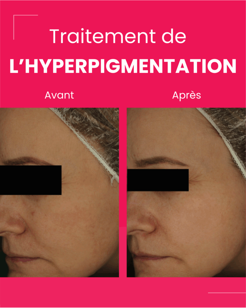 Retix C retibooster hyperpigmentation