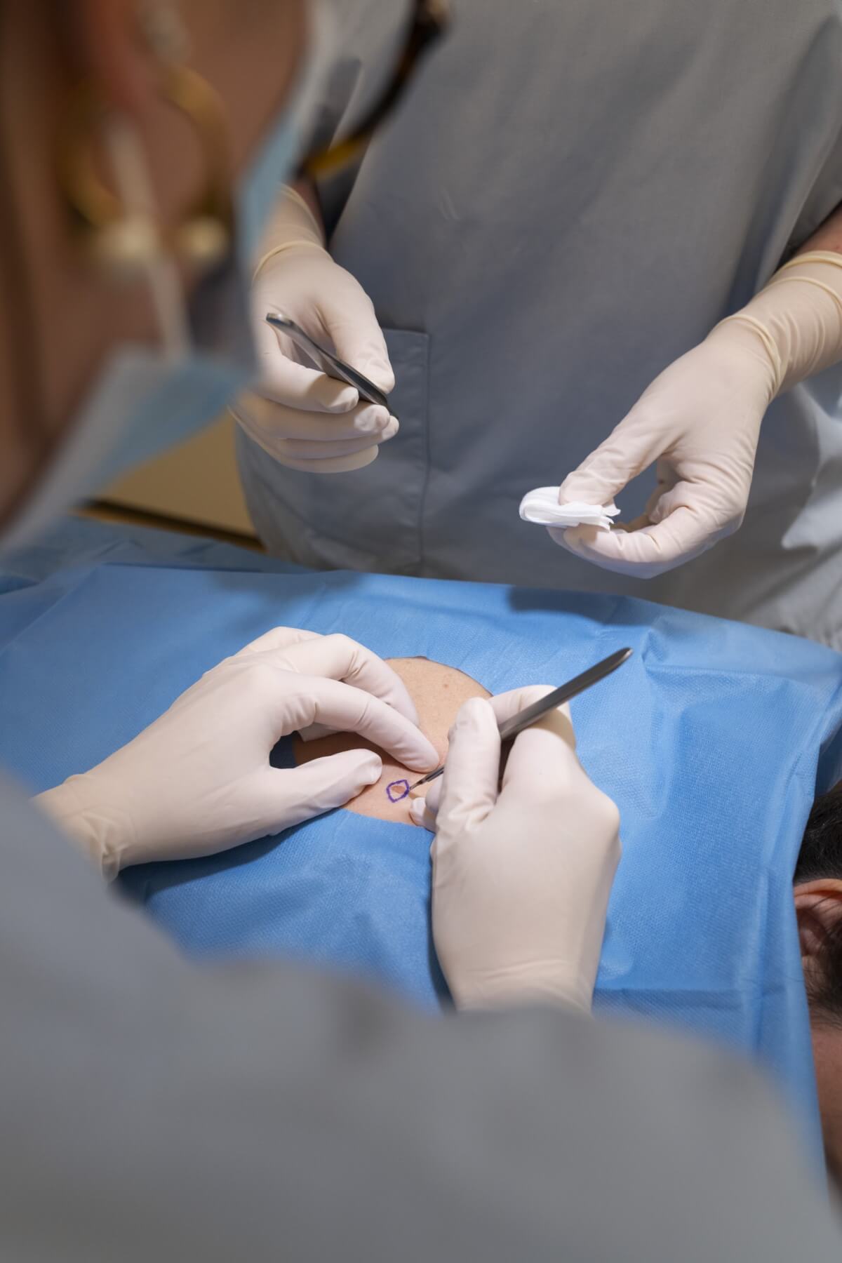 Docteur Marine HITIER - chirurgie tumeurs cutanées à Annecy